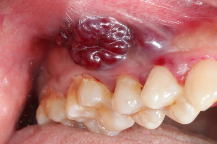 white gums